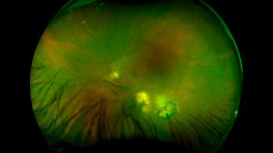 uveitis toxoplasmosi