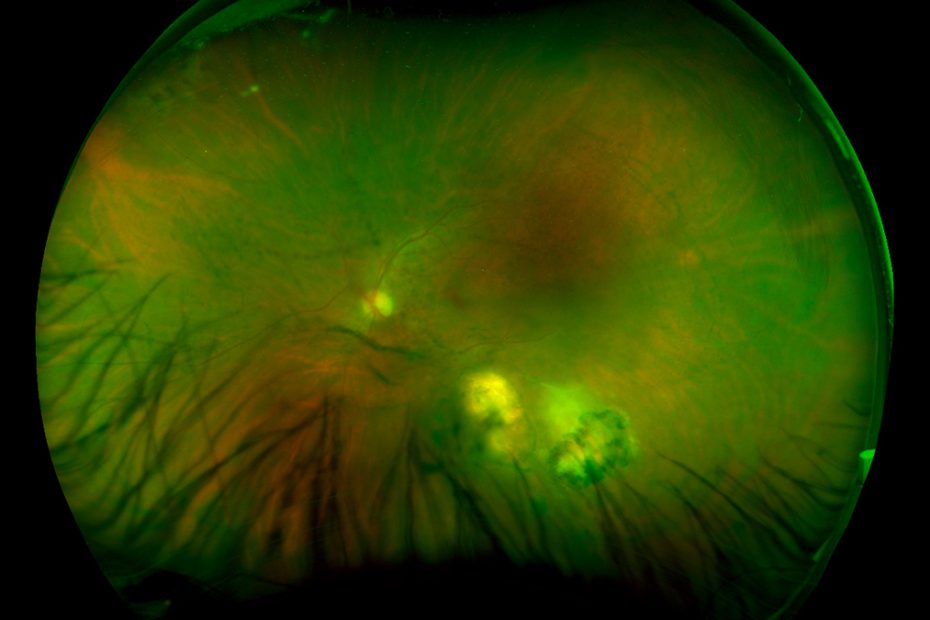 uveitis infecciosa toxoplasmosi