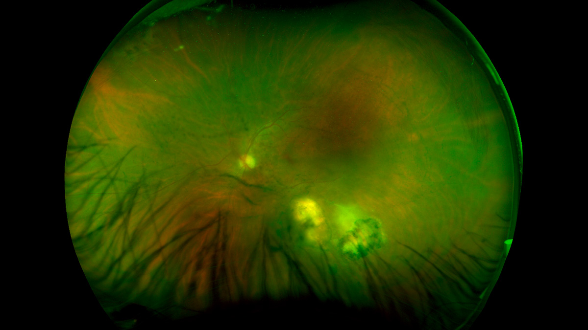 uveitis infecciosa toxoplasmosi